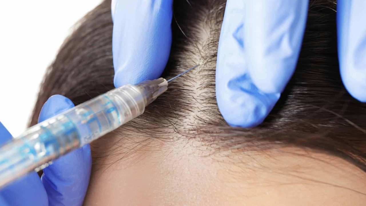 Hair Transplant Birmingham – Minimally Invasive FUE Solutions